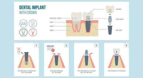 Dental Implants: The Choice for Restoring Your Smile